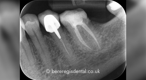 Root Canal