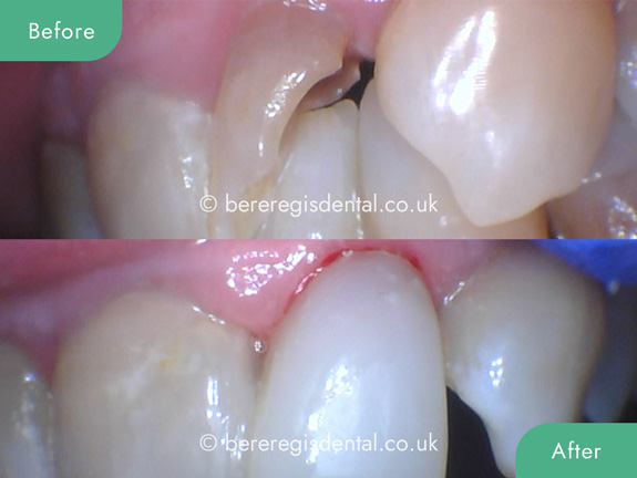 How can I prevent chipped or cracked teeth